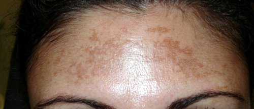 eliminare macchie viso laser